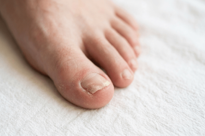 Como acabar com micose de unha? Biólogo revela receita caseira simples