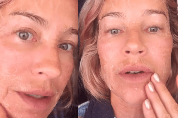 Luana Piovani explica descamação no rosto: “Fazendo 50 com cara de 100”