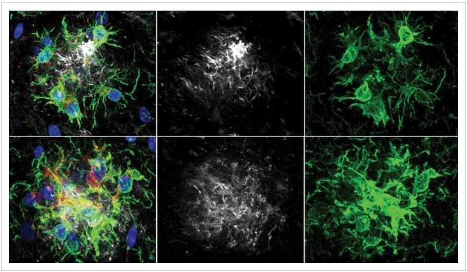Pesquisadores descobrem maneira de retardar perda de memória no Alzheimer