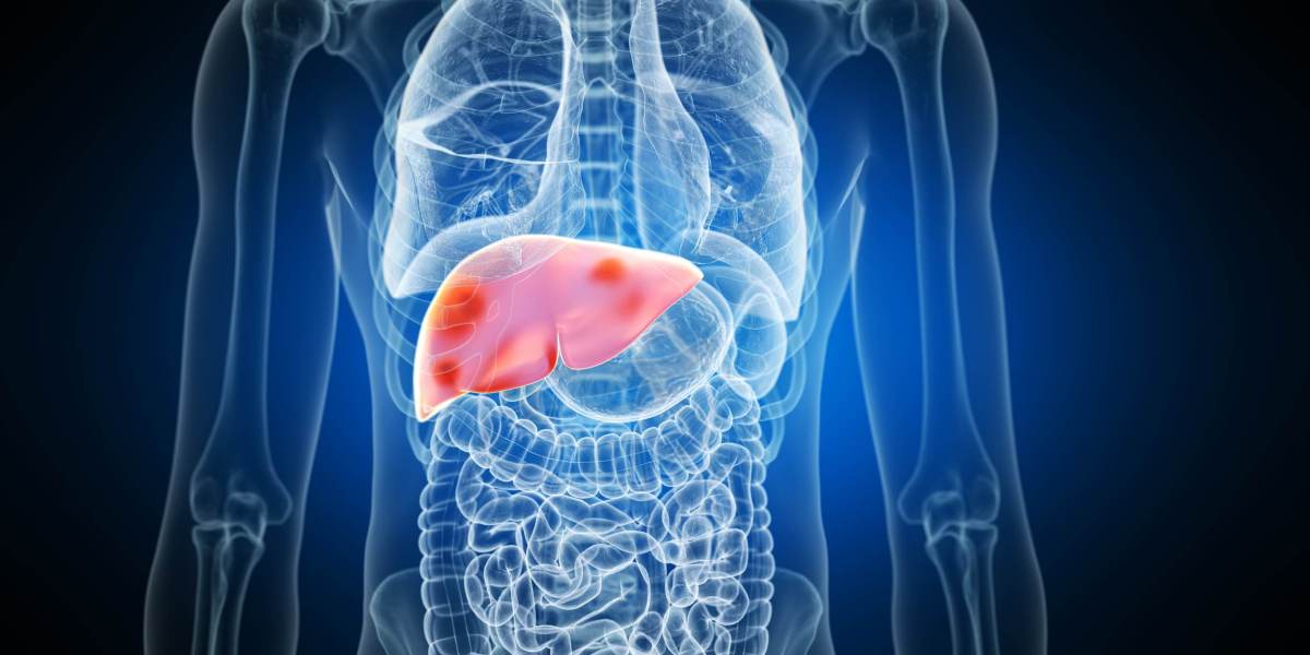 Dr. Kalil e especialistas explicam o que é síndrome metabólica do fígado