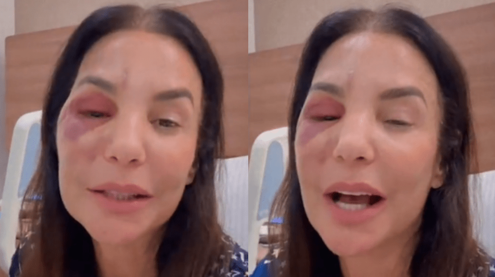 Ivete Sangalo mostra inchaço no rosto após cirurgia: “Quebrei dois ossos”