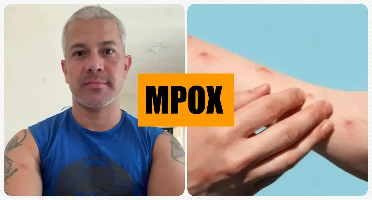 Servidor público de Porto Velho relata diagnóstico de Mpox e alerta para sintomas da doença