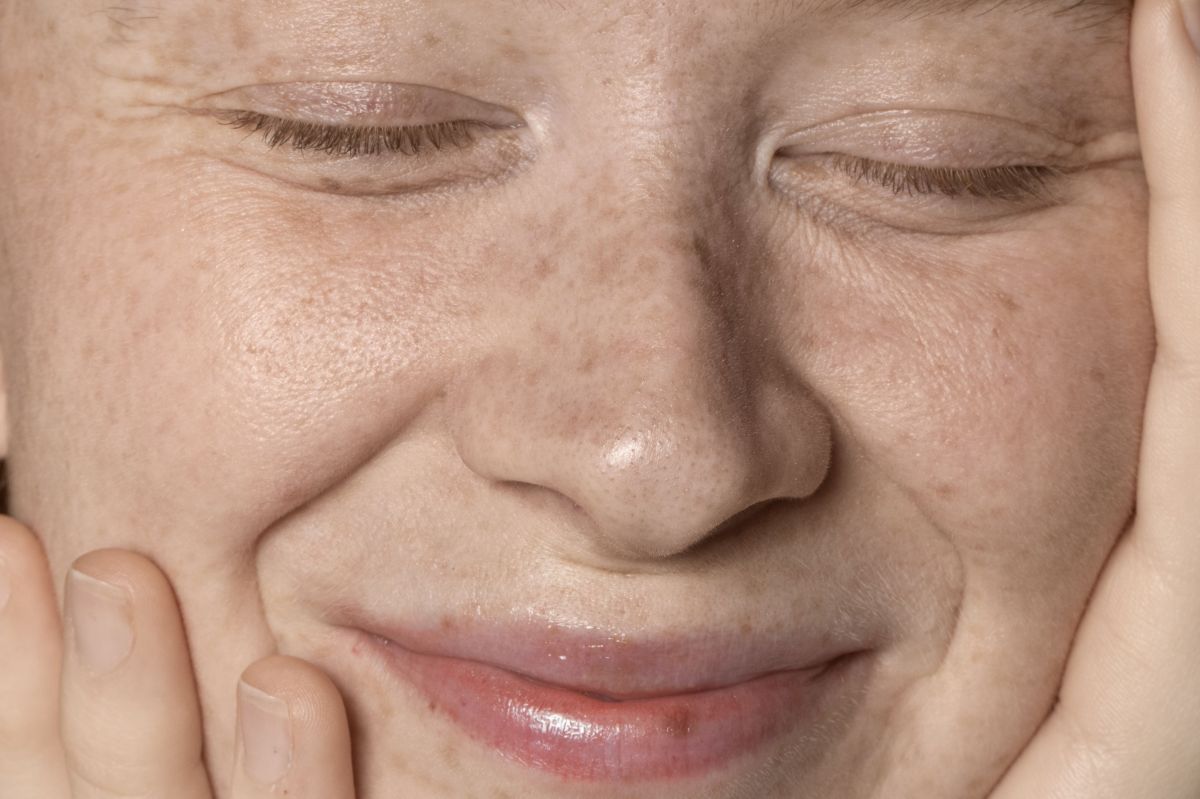 Como prevenir manchas e hiperpigmentação após o verão?