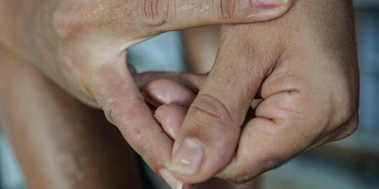 Como a dermatite atópica afeta a pele, o sono e a autoestima: tratamentos disponíveis