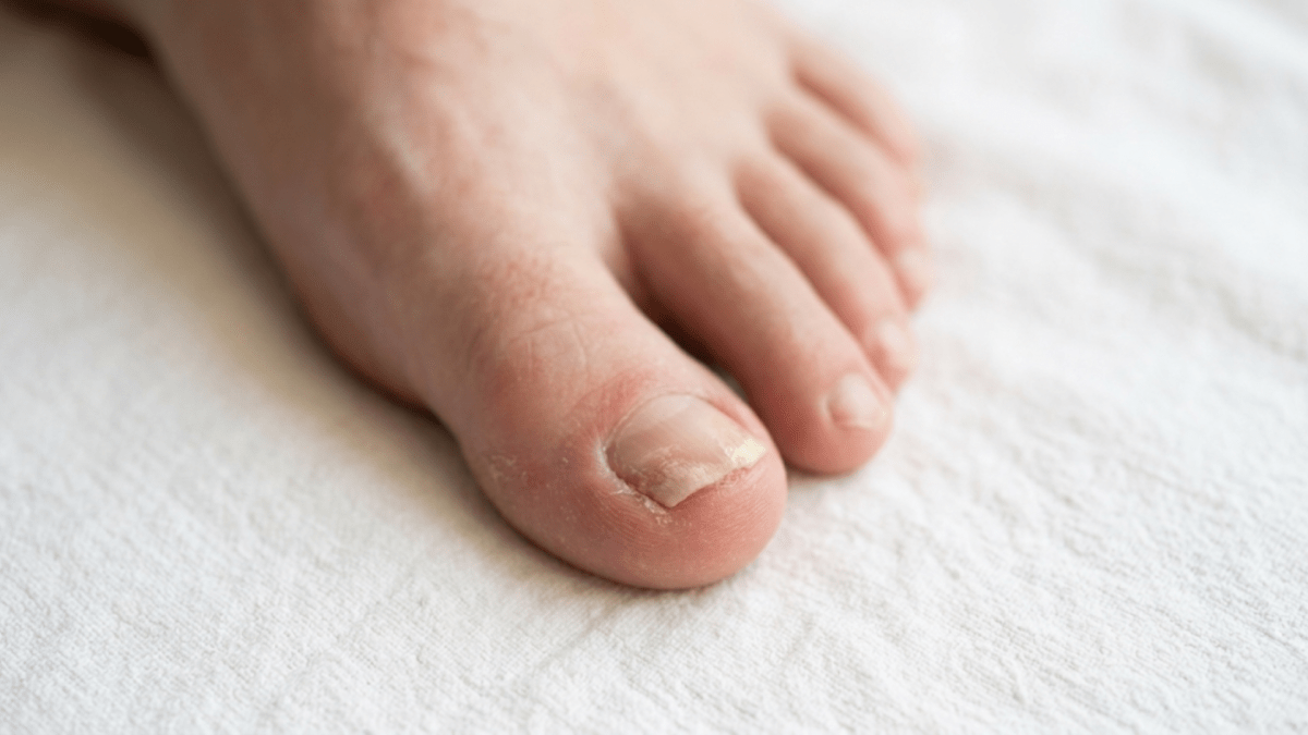 Como acabar com micose de unha? Biólogo revela receita caseira simples