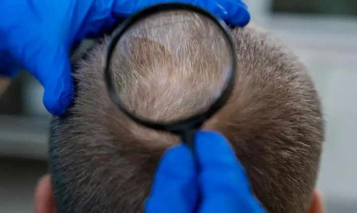 Cabelo não cresce de dentro para fora, mas é puxado para cima, diz estudo